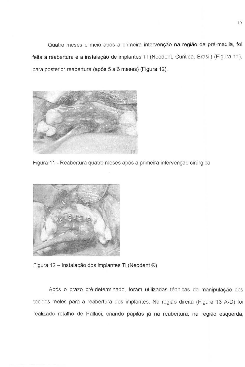 Figura 11 - Reabertura quatro meses ap6s a prime ira intervenc;ao cirurgica Figura 12 -Instalac;ao dos implantes Ti (Neodent ) Ap6s a prazo