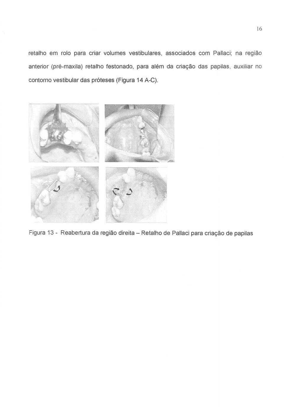 papilas, auxiliar no eontorno vestibular das proteses (Figura 14 A-C).