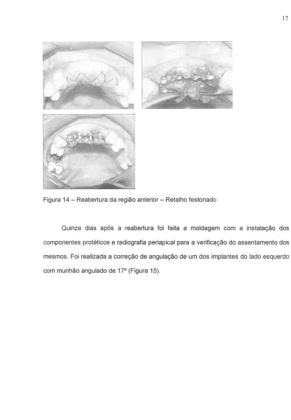 radiografia periapical para a verificac;ao do assentamento dos mesmos.