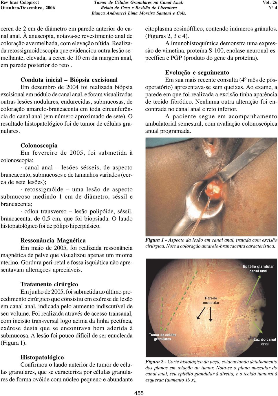 Conduta inicial Biópsia excisional Em dezembro de 2004 foi realizada biópsia excisional em nódulo de canal anal, e foram visualizadas outras lesões nodulares, endurecidas, submucosas, de coloração