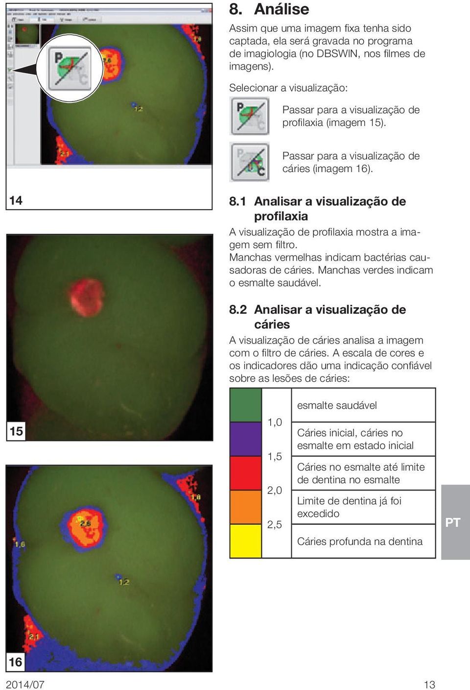 1 Analisar a visualização de profilaxia A visualização de profilaxia mostra a imagem sem filtro. Manchas vermelhas indicam bactérias causadoras de cáries. Manchas verdes indicam o esmalte saudável. 8.