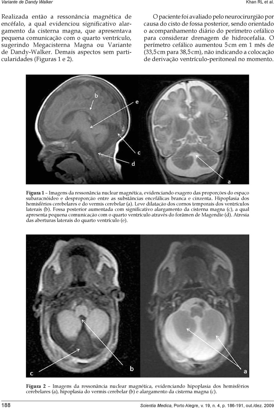 O paciente foi avaliado pelo neurocirurgião por causa do cisto de fossa posterior, sendo orientado o acompanhamento diário do perímetro cefálico para considerar drenagem de hidrocefalia.