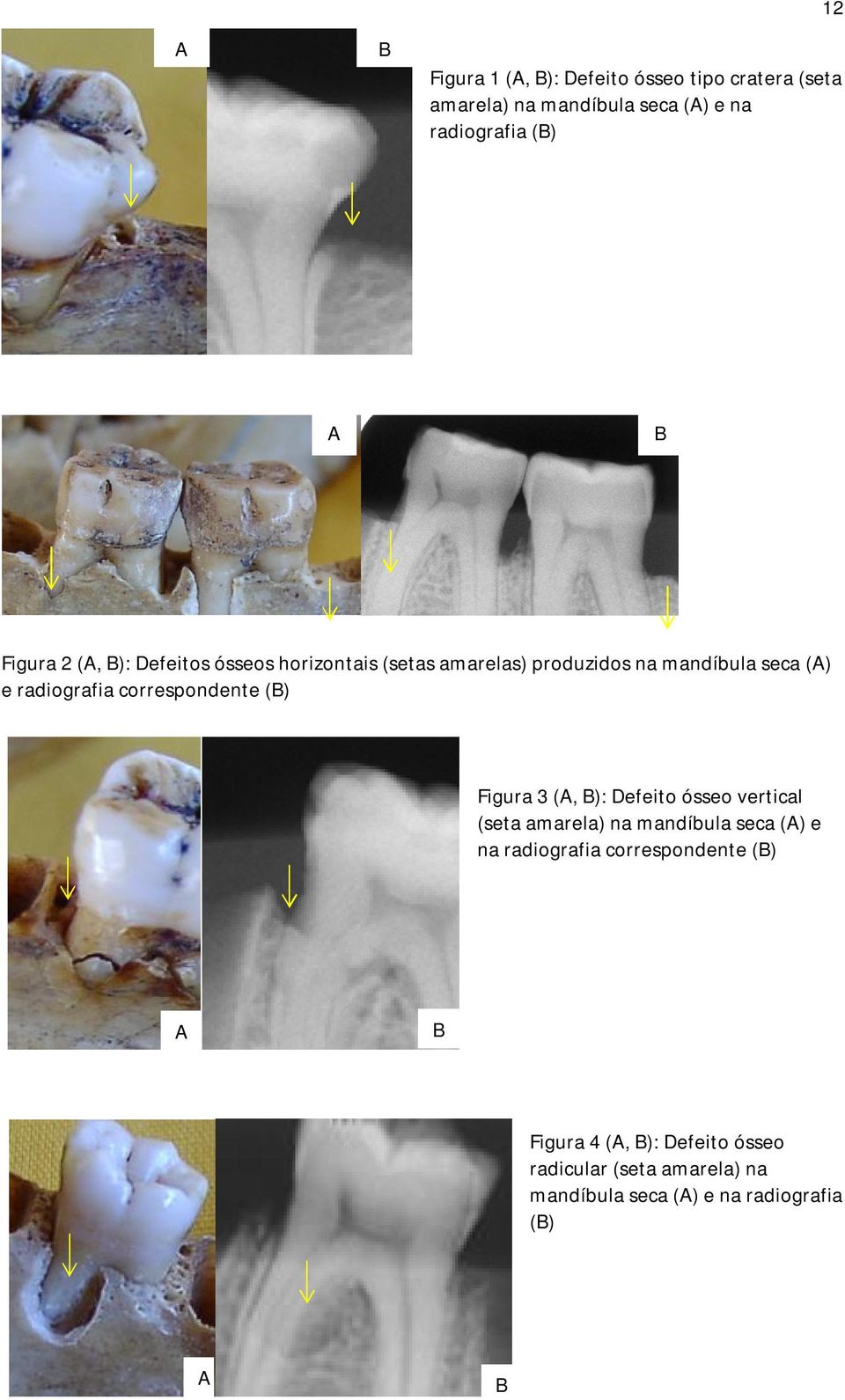 correspondente (B) Figura 3 (A, B): Defeito ósseo vertical (seta amarela) na mandíbula seca (A) e na radiografia