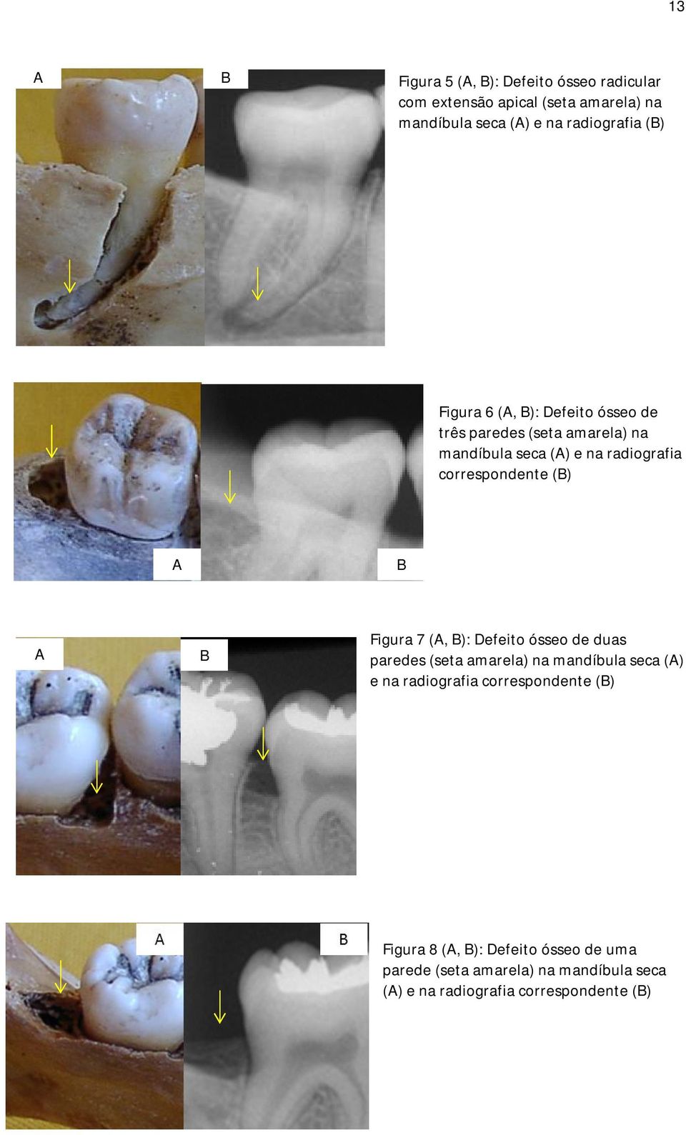 (B) A B A B Figura 7 (A, B): Defeito ósseo de duas paredes (seta amarela) na mandíbula seca (A) e na radiografia