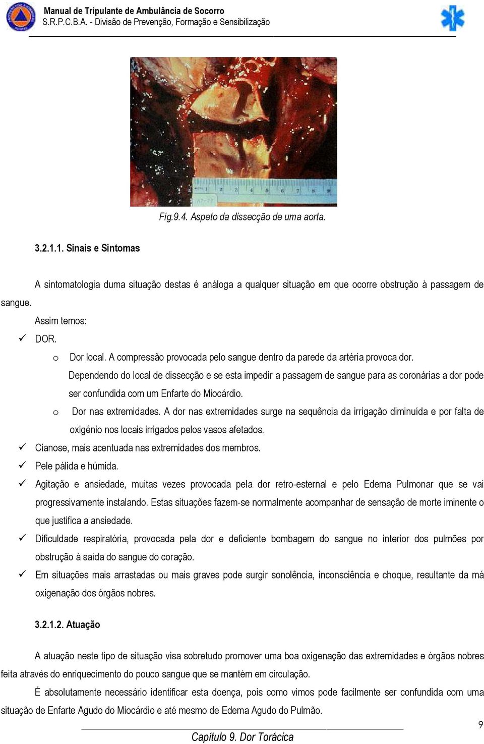 Dependendo do local de dissecção e se esta impedir a passagem de sangue para as coronárias a dor pode ser confundida com um Enfarte do Miocárdio. o Dor nas extremidades.