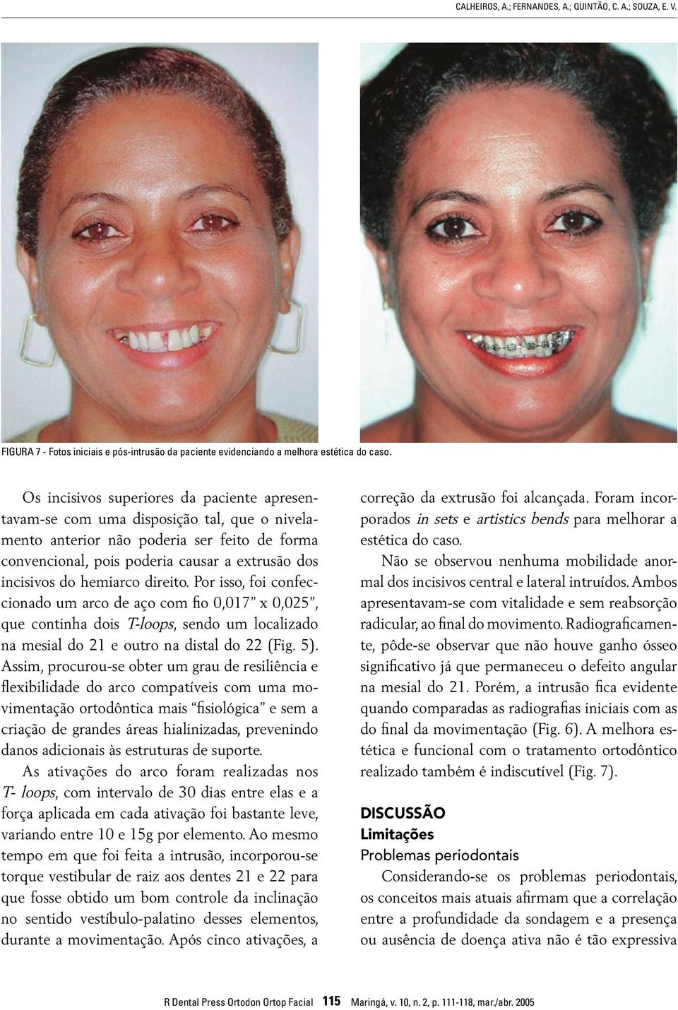 hemiarco direito. Por isso, foi confeccionado um arco de aço com fio 0,017 x 0,025, que continha dois T-loops, sendo um localizado na mesial do 21 e outro na distal do 22 (Fig. 5).