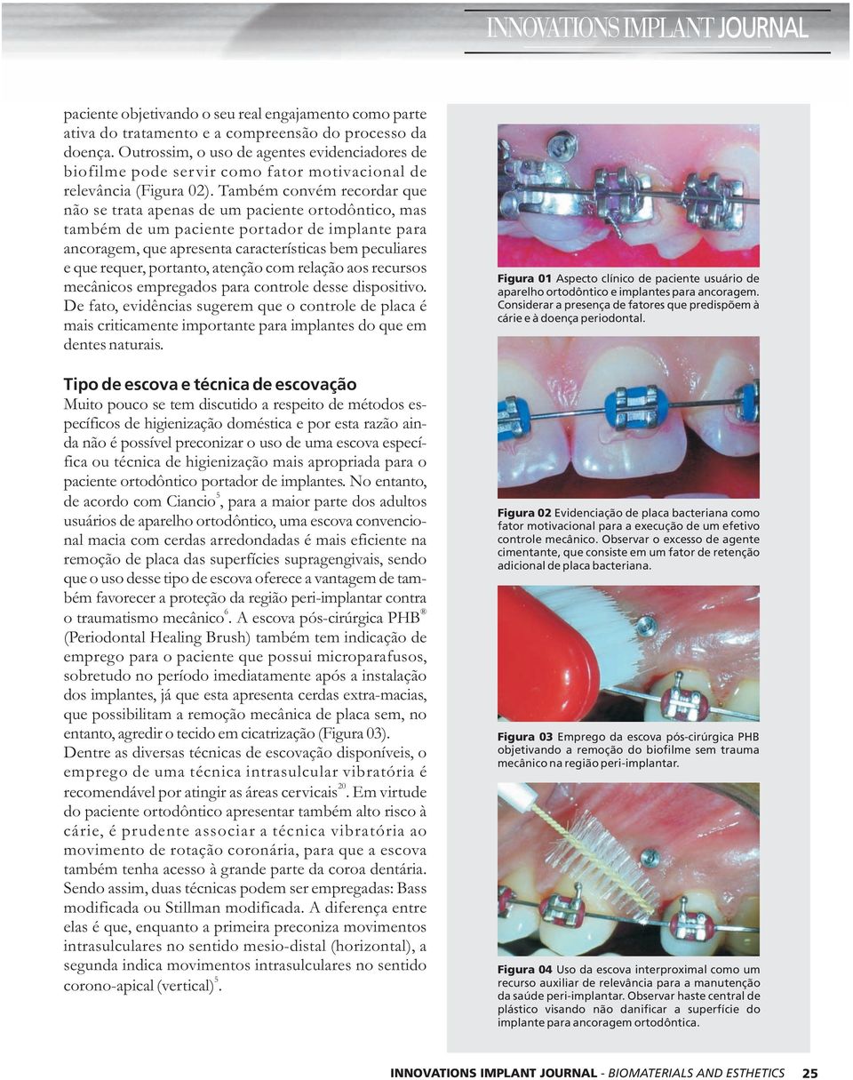 Também convém recordar que não se trata apenas de um paciente ortodôntico, mas também de um paciente portador de implante para ancoragem, que apresenta características bem peculiares e que requer,