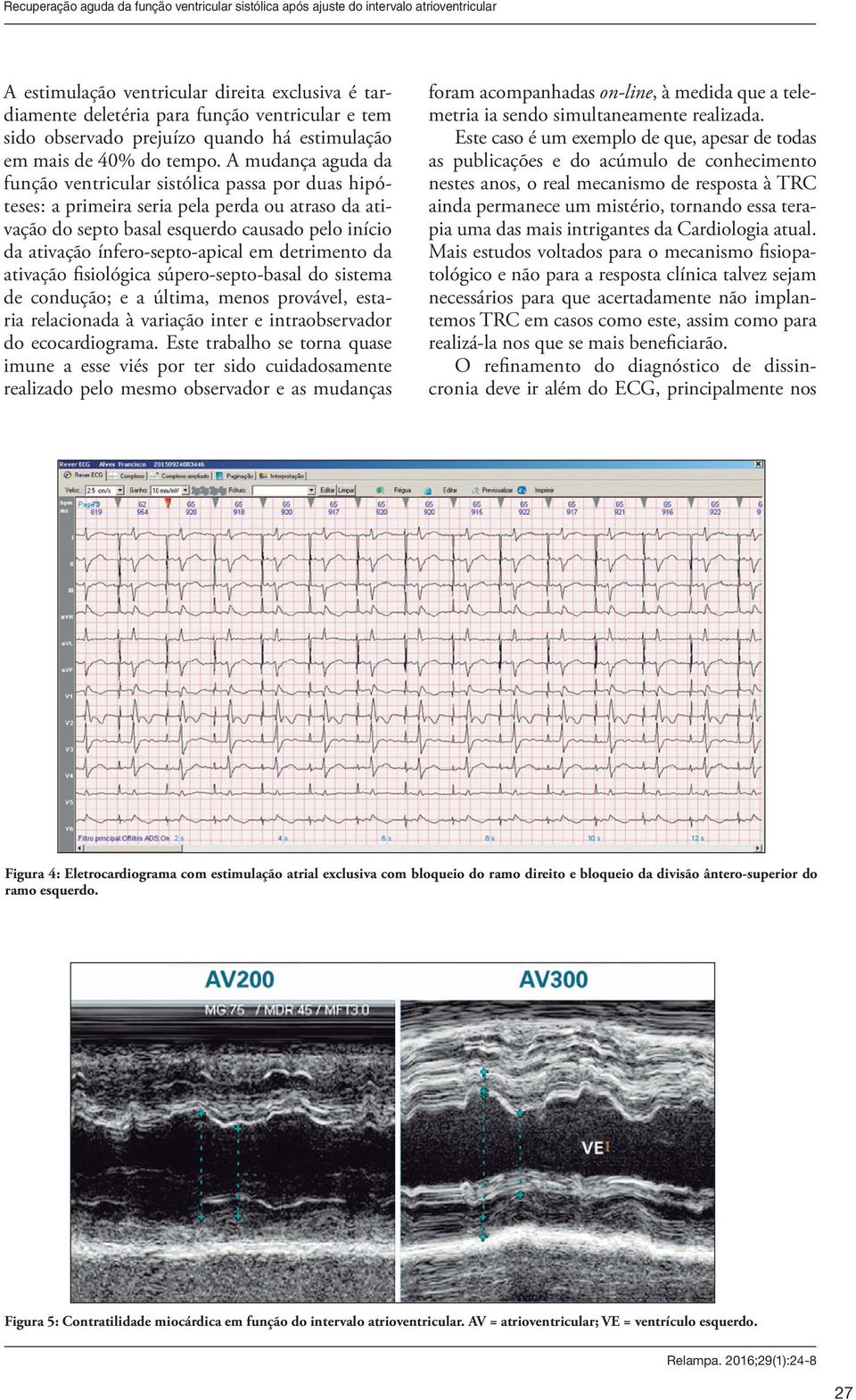 A mudança aguda da função ventricular sistólica passa por duas hipóteses: a primeira seria pela perda ou atraso da ativação do septo basal esquerdo causado pelo início da ativação ínfero-septo-apical