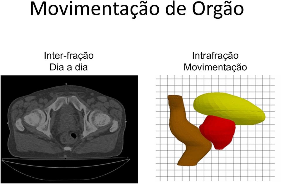 Inter-fração Dia