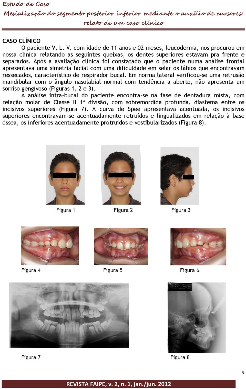 respirador bucal. Em norma lateral verificou-se uma retrusão mandibular com o ângulo nasolabial normal com tendência a aberto, não apresenta um sorriso gengivoso (Figuras 1, 2 e 3).
