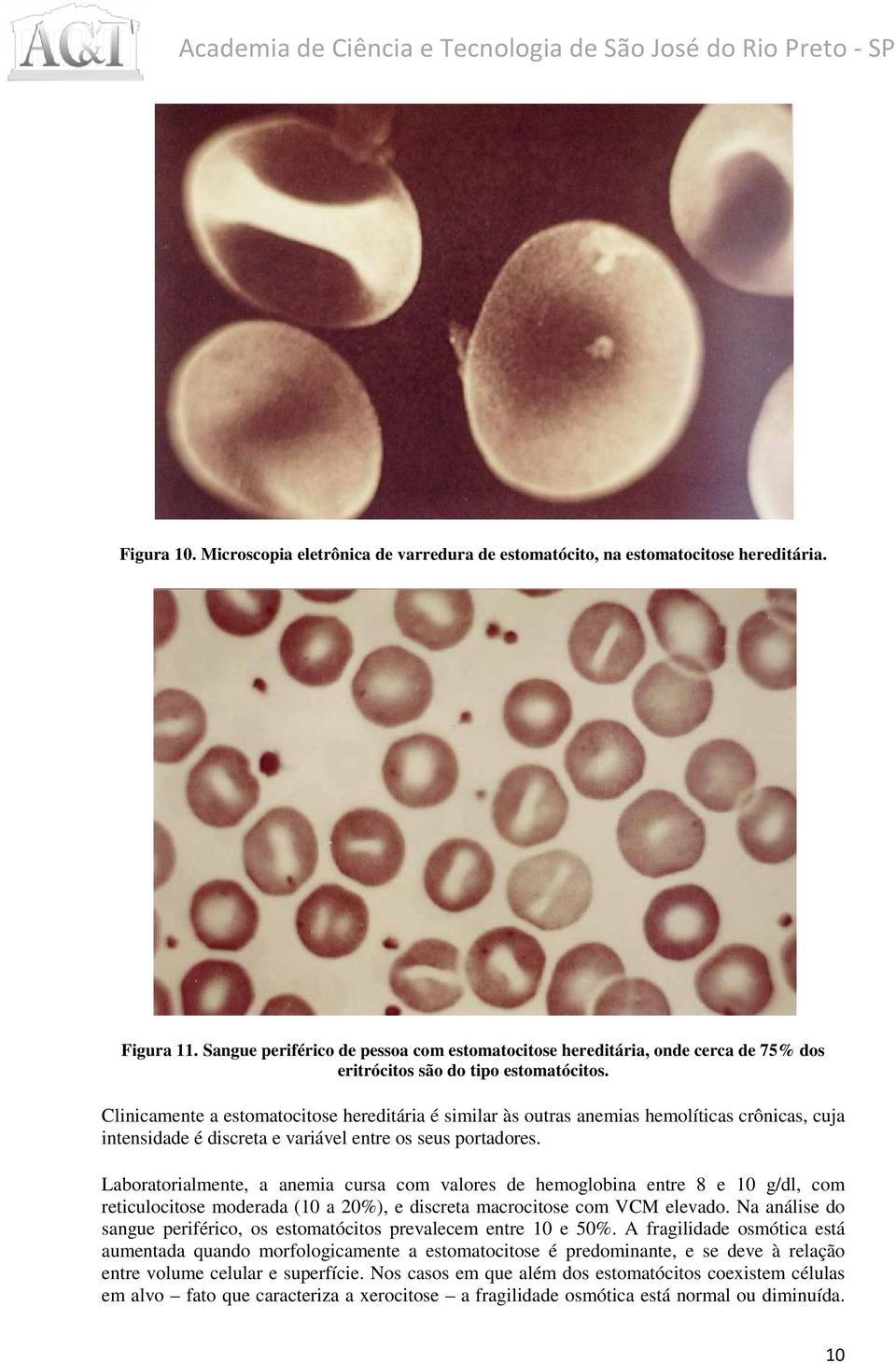 Clinicamente a estomatocitose hereditária é similar às outras anemias hemolíticas crônicas, cuja intensidade é discreta e variável entre os seus portadores.