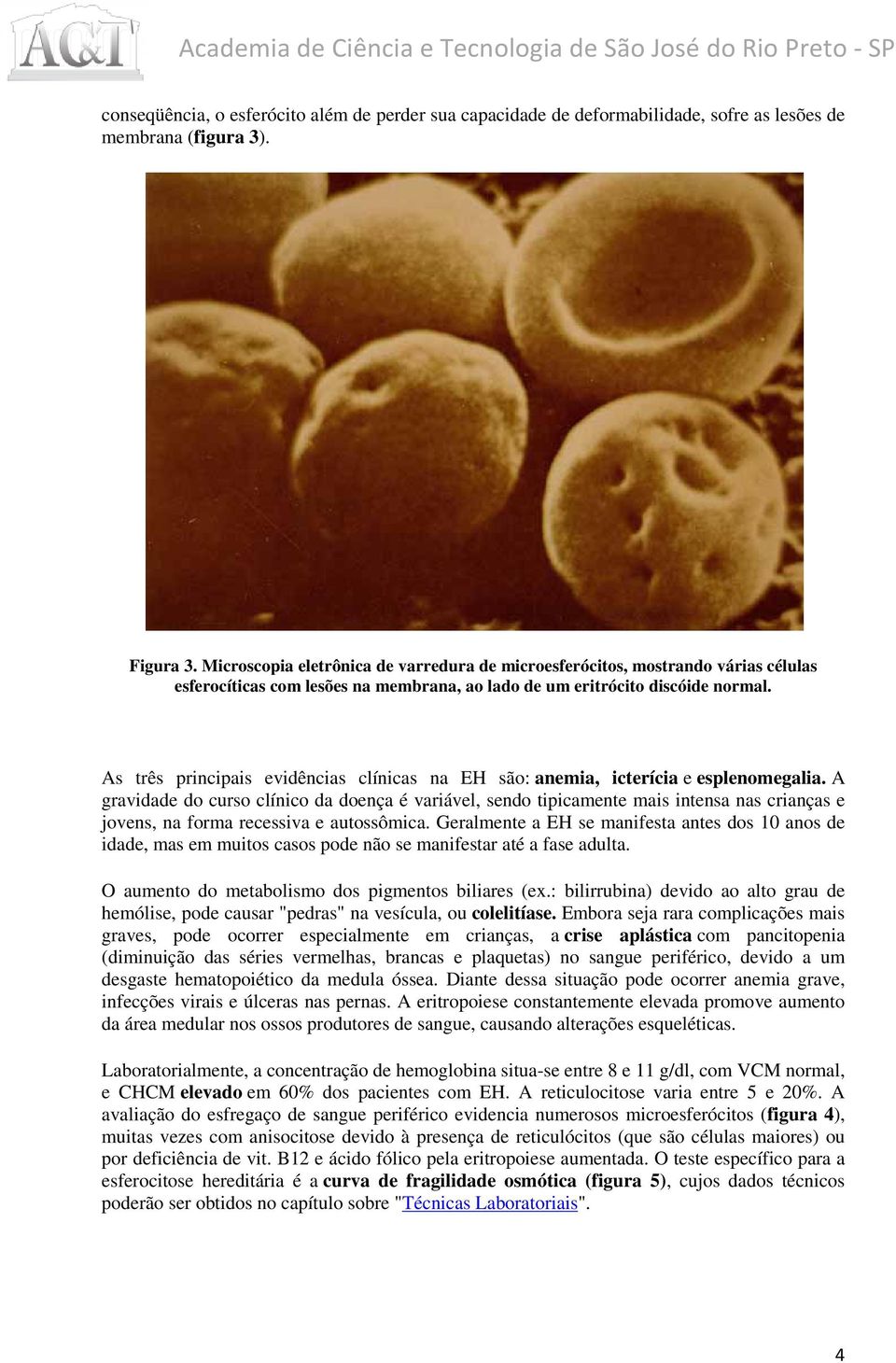 As três principais evidências clínicas na EH são: anemia, icterícia e esplenomegalia.