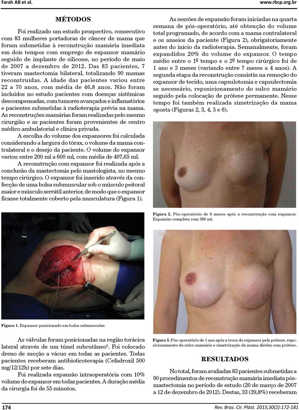 mamário seguido de implante de silicone, no período de maio de 2007 a dezembro de 2012. Das 83 pacientes, 7 tiveram mastectomia bilateral, totalizando 90 mamas reconstruídas.