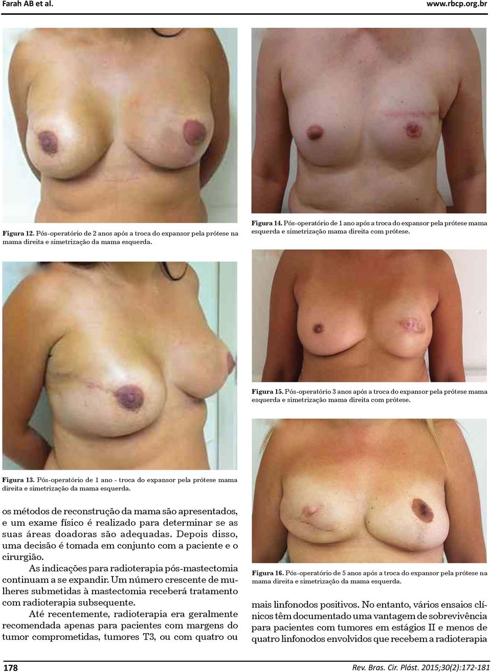 Pós-operatório 3 anos após a troca do expansor pela prótese mama esquerda e simetrização mama direita com prótese. Figura 13.