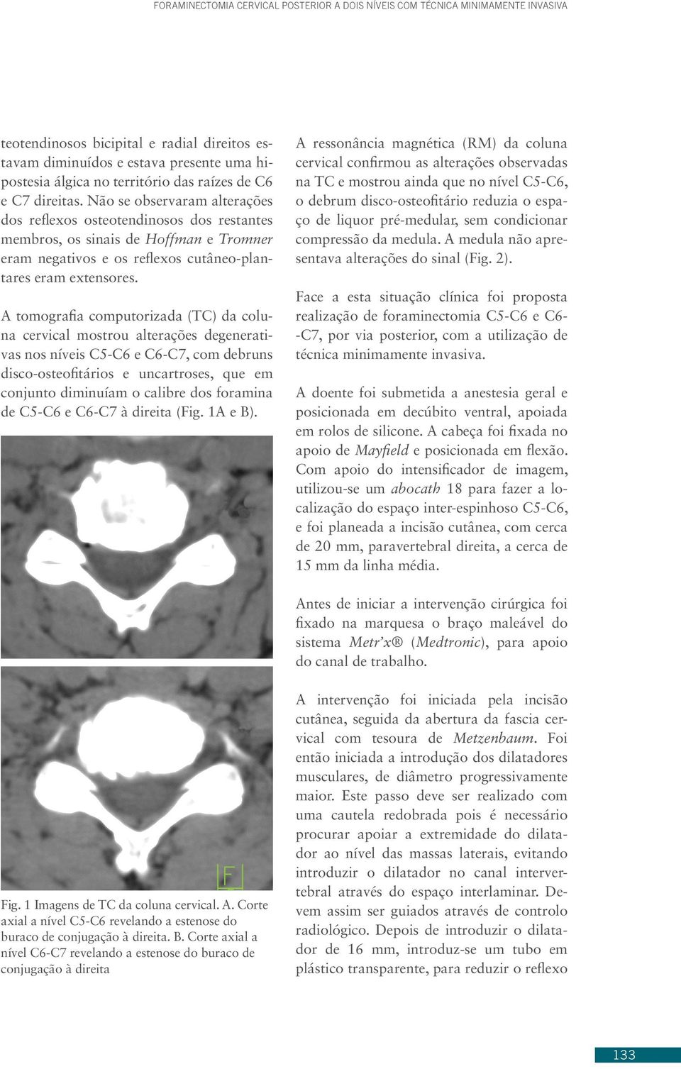 Não se observaram alterações dos reflexos osteotendinosos dos restantes membros, os sinais de Hoffman e Tromner eram negativos e os reflexos cutâneo-plantares eram extensores.