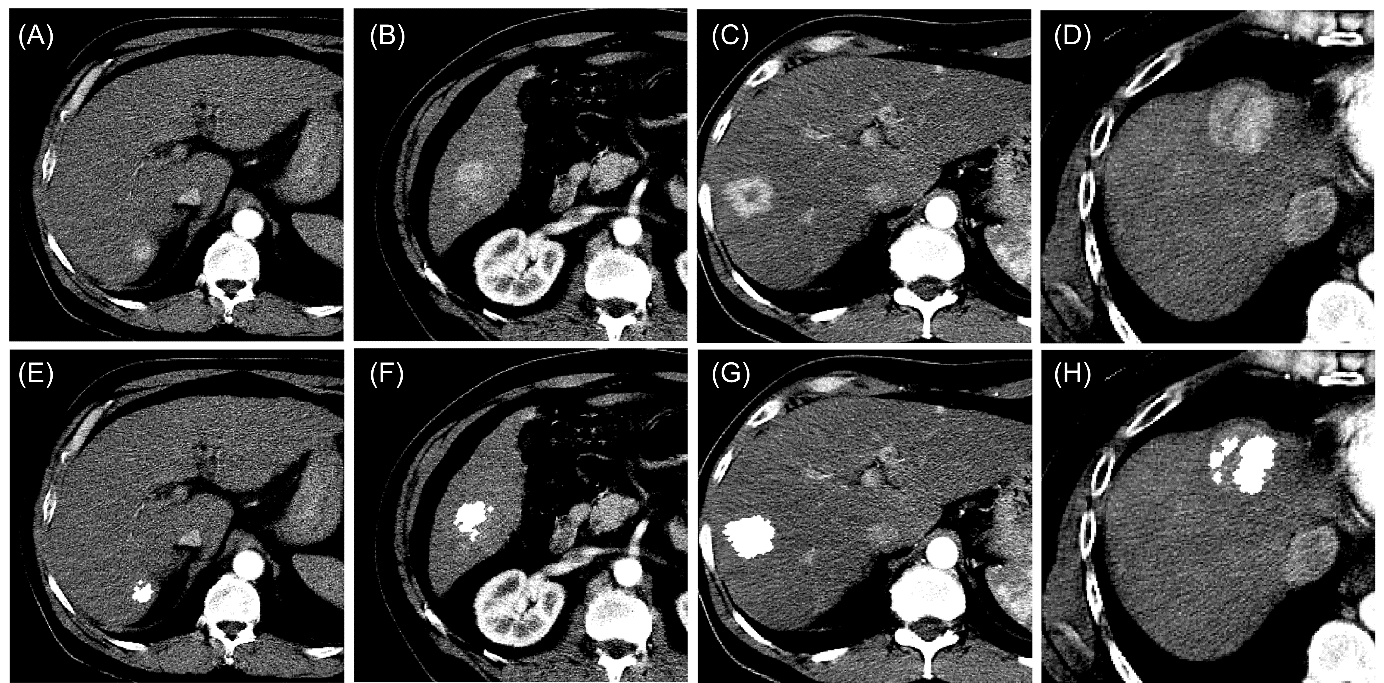 CAPÍTULO 4 RESULTADOS Fig 16. Exemplos da segmentação do CHC em quatro corte tomográficos. (A-D) corte tomográfico antes da segmentação. (E-H) corte tomográfico após a segmentação.