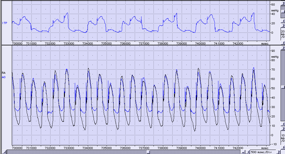 Ventilação x PPC 12 vent/min PPC 23,4 mmhg 30