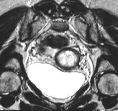 b Fig. 8 - Adenocarcinoma bem diferenciado do colo do útero em mulher com 51 anos de idade e Sagital e axial T2: tumor com crescimento endocervical com áreas focais com hiper-sinal. Fig. 9 - Adenocarcinoma de tipo endometrióide do colo em mulher com 76 anos de idade.