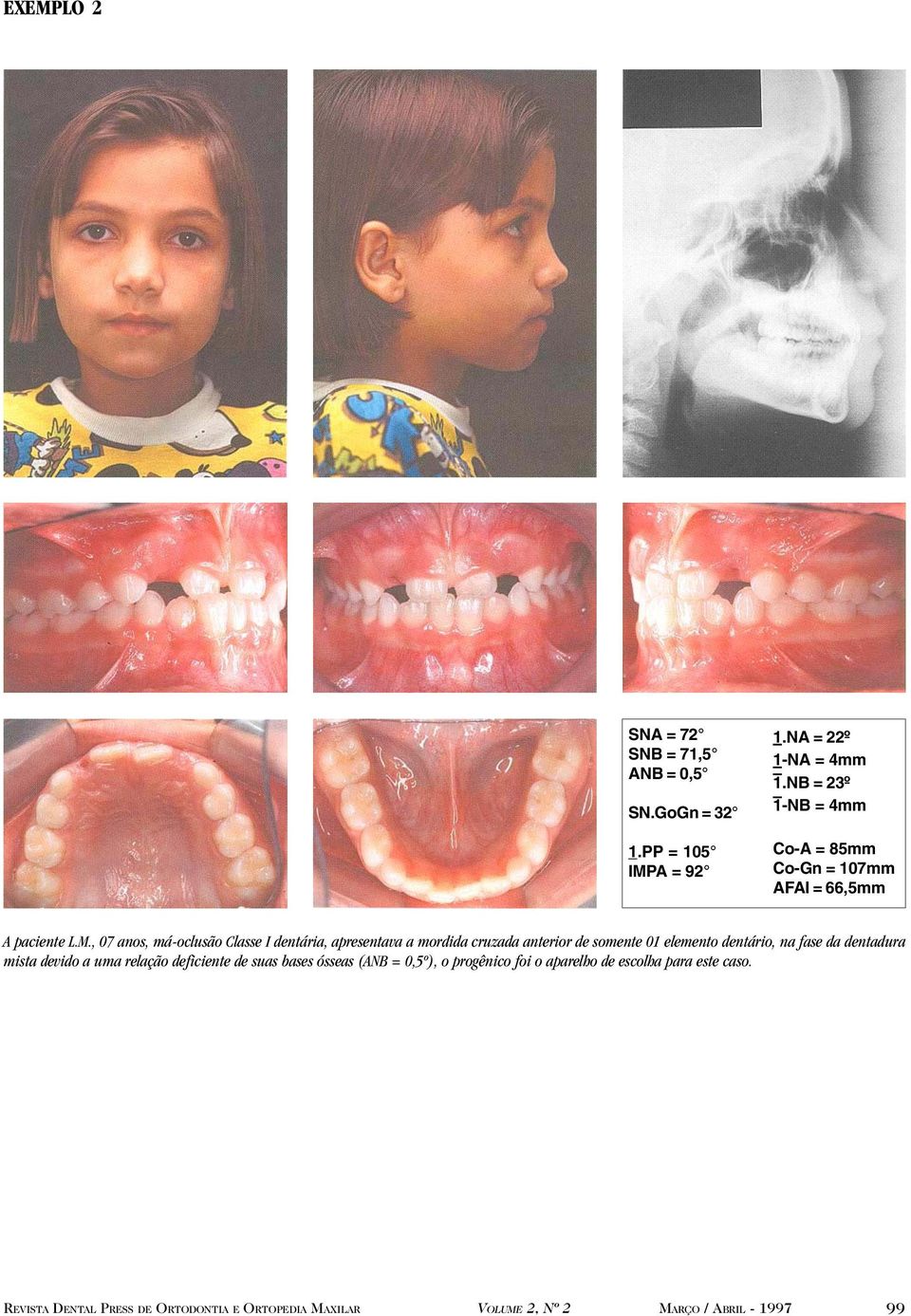 , 07 anos, má-oclusão Classe I dentária, apresentava a mordida cruzada anterior de somente 01 elemento