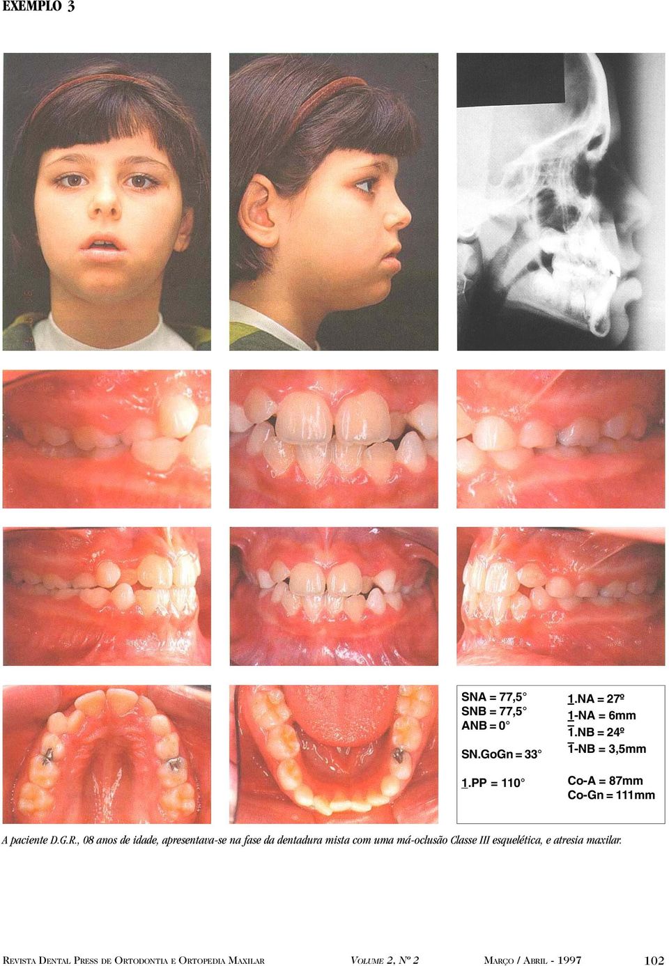 NB = 24º 1-NB = 3,5mm Co-A = 87mm Co-Gn = 111mm A paciente D.G.R.