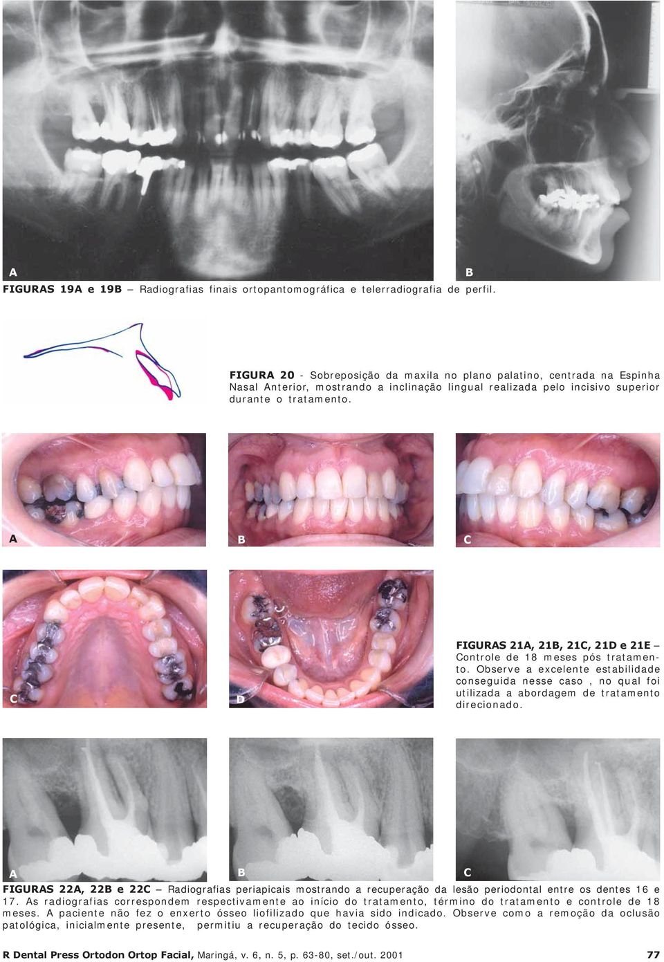 A B C C D FIGURAS 21A, 21B, 21C, 21D e 21E Controle de 18 meses pós tratamento. Observe a excelente estabilidade conseguida nesse caso, no qual foi utilizada a abordagem de tratamento direcionado.