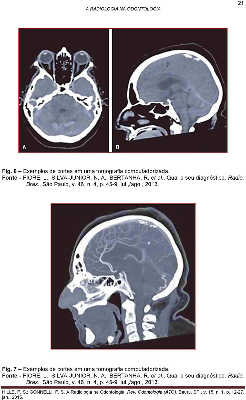 , 2013. Fig. 7 Exemplos de cortes em uma tomografia computadorizada. Fonte - FIORE, L.; SILVA-JUNIOR. N.