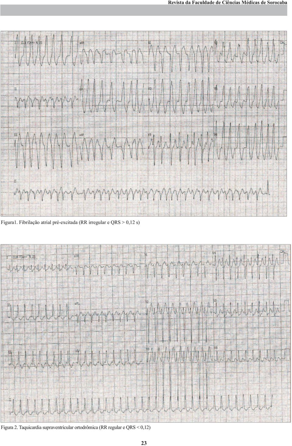 Fibrilação atrial pré-excitada (RR irregular e