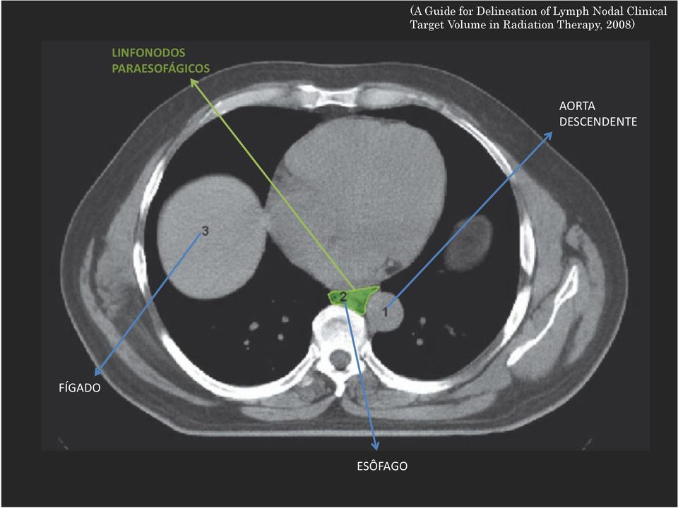 Radiation Therapy, 2008) LINFONODOS