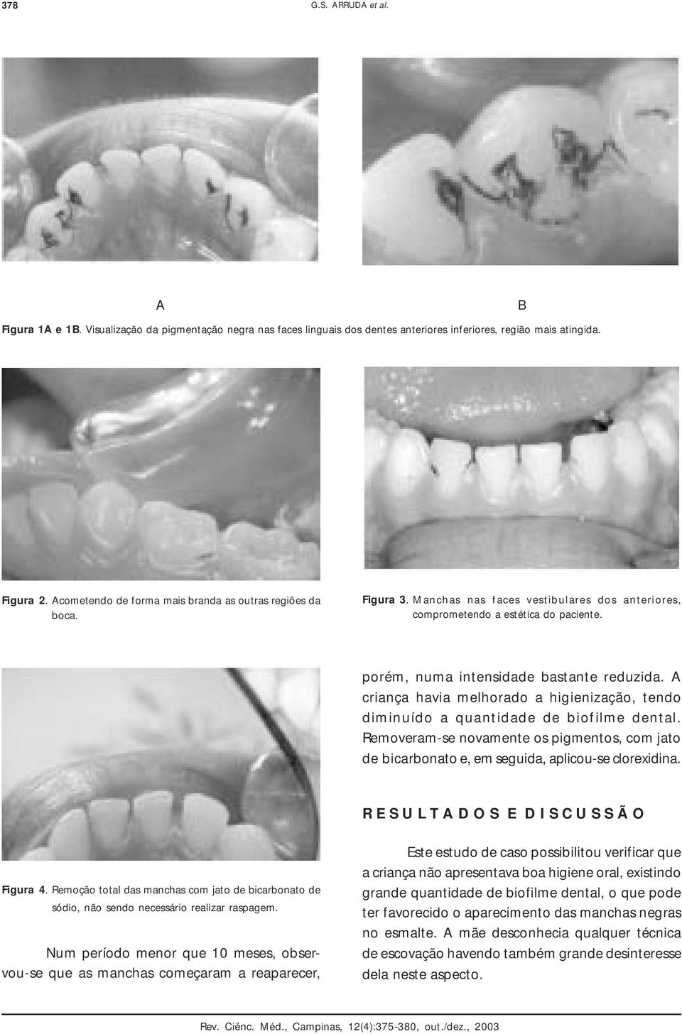 A criança havia melhorado a higienização, tendo diminuído a quantidade de biofilme dental. Removeram-se novamente os pigmentos, com jato de bicarbonato e, em seguida, aplicou-se clorexidina.