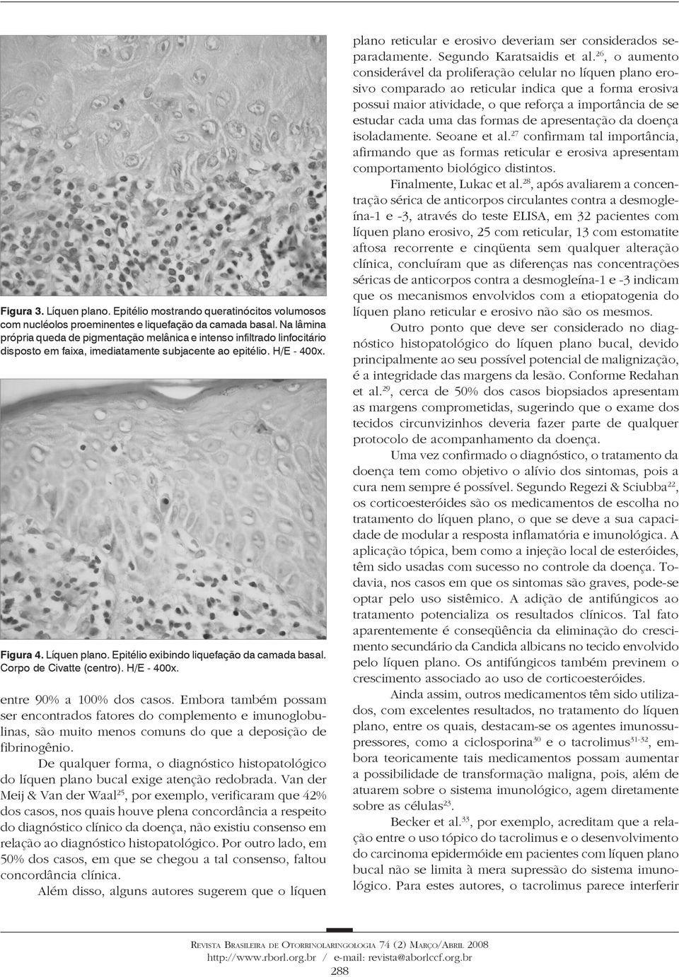 Epitélio exibindo liquefação da camada basal. Corpo de Civatte (centro). H/E - 400x. entre 90% a 100% dos casos.