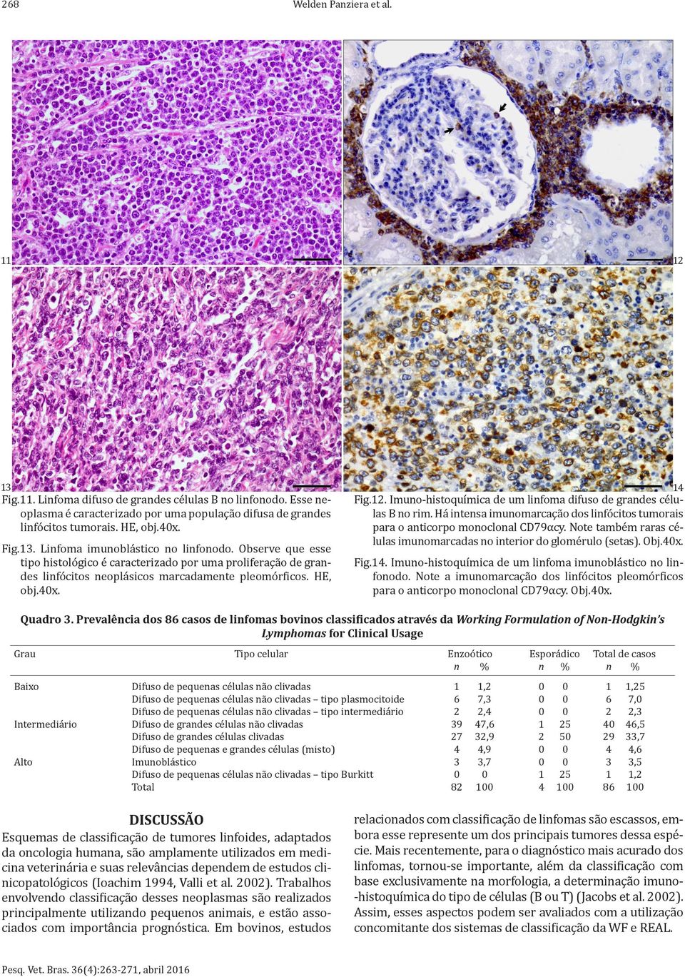 Imuno-histoquímica de um linfoma difuso de grandes células B no rim. Há intensa imunomarcação dos linfócitos tumorais para o anticorpo monoclonal CD79αcy.