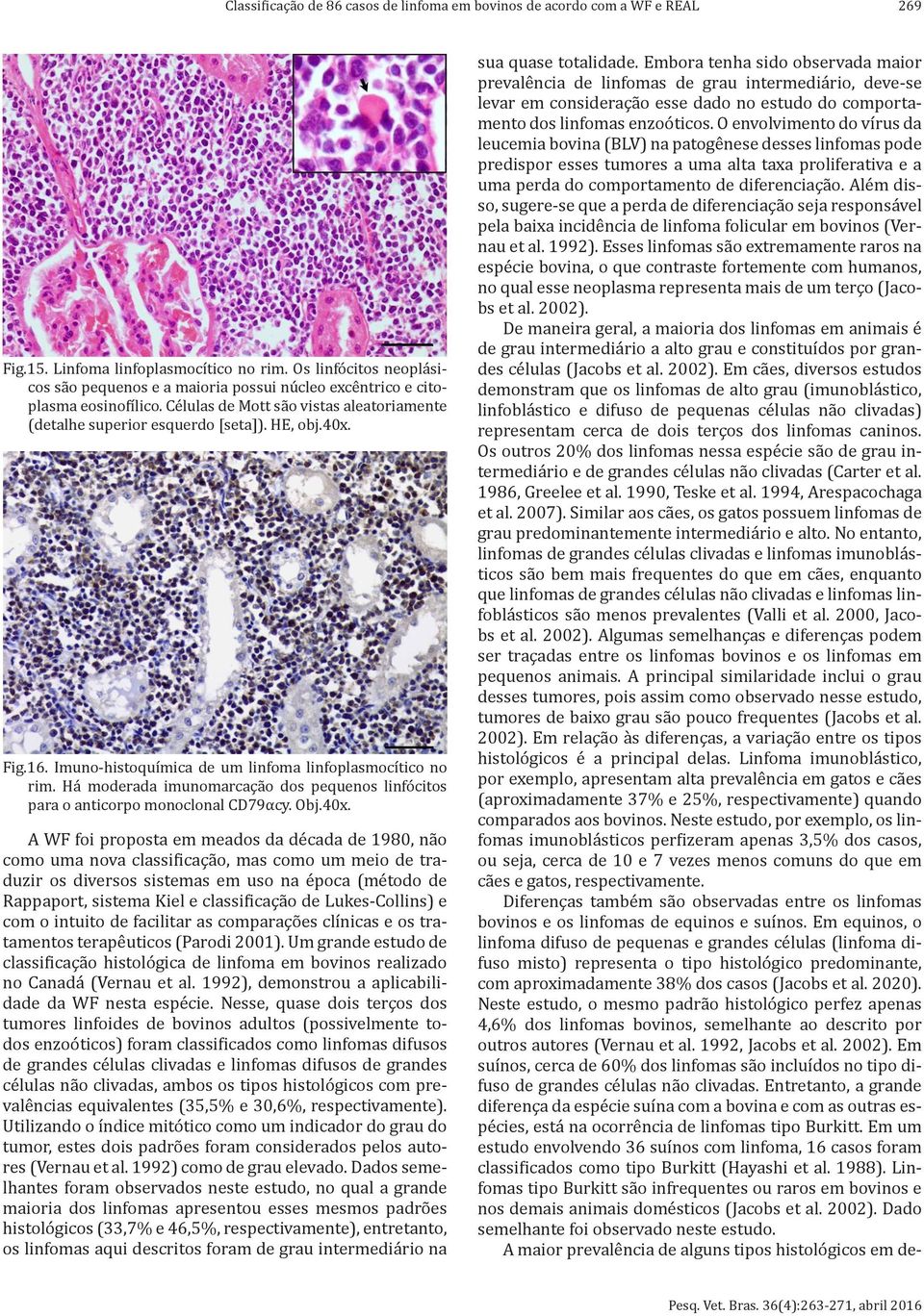 16. Imuno-histoquímica de um linfoma linfoplasmocítico no rim. Há moderada imunomarcação dos pequenos linfócitos para o anticorpo monoclonal CD79αcy. Obj.40x.