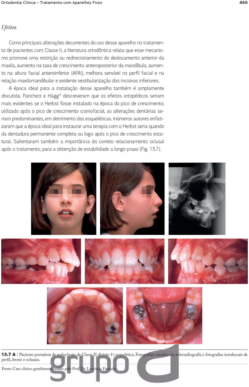 (AFAI), melhora sensível no perfil facial e na relação maxilomandibular e evidente vestibularização dos incisivos inferiores.