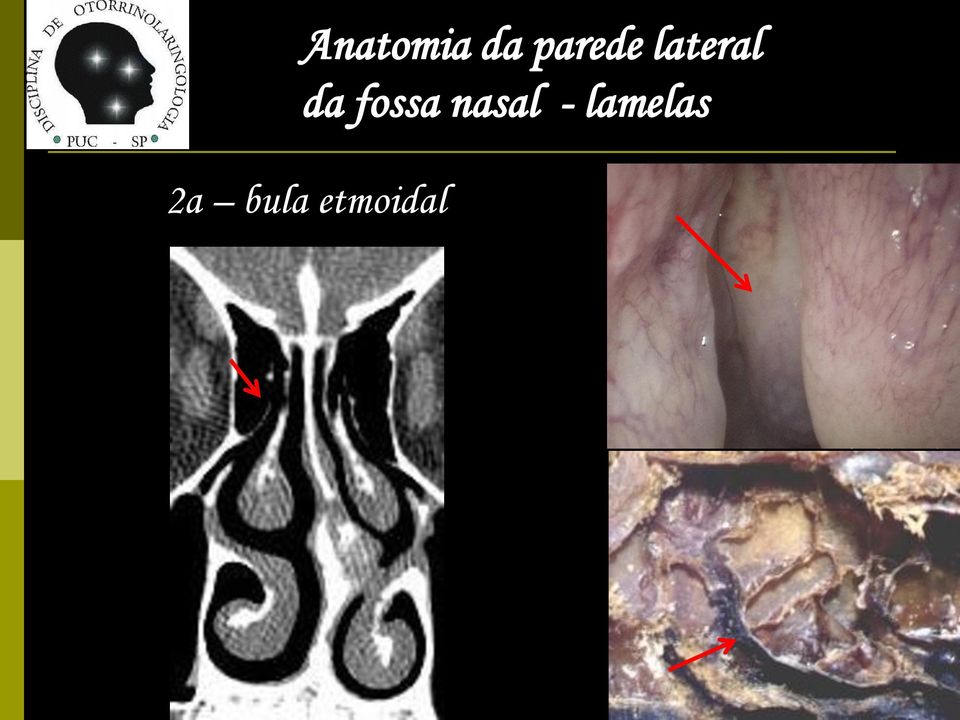 da fossa nasal -