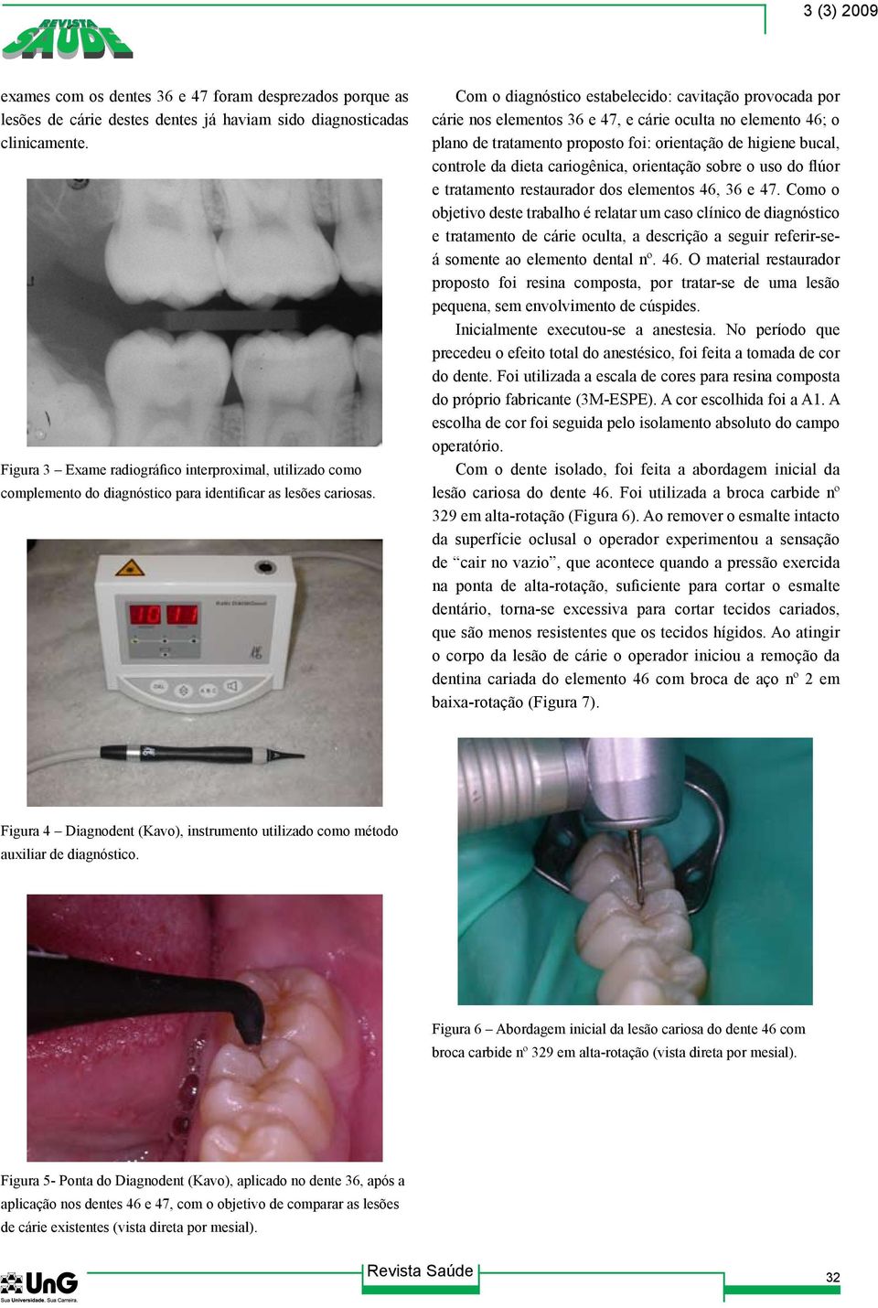 Com o diagnóstico estabelecido: cavitação provocada por cárie nos elementos 36 e 47, e cárie oculta no elemento 46; o plano de tratamento proposto foi: orientação de higiene bucal, controle da dieta