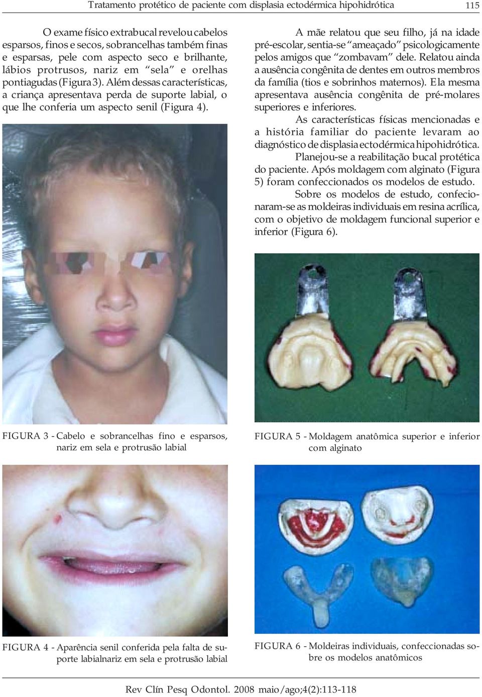 Além dessas características, a criança apresentava perda de suporte labial, o que lhe conferia um aspecto senil (Figura 4).