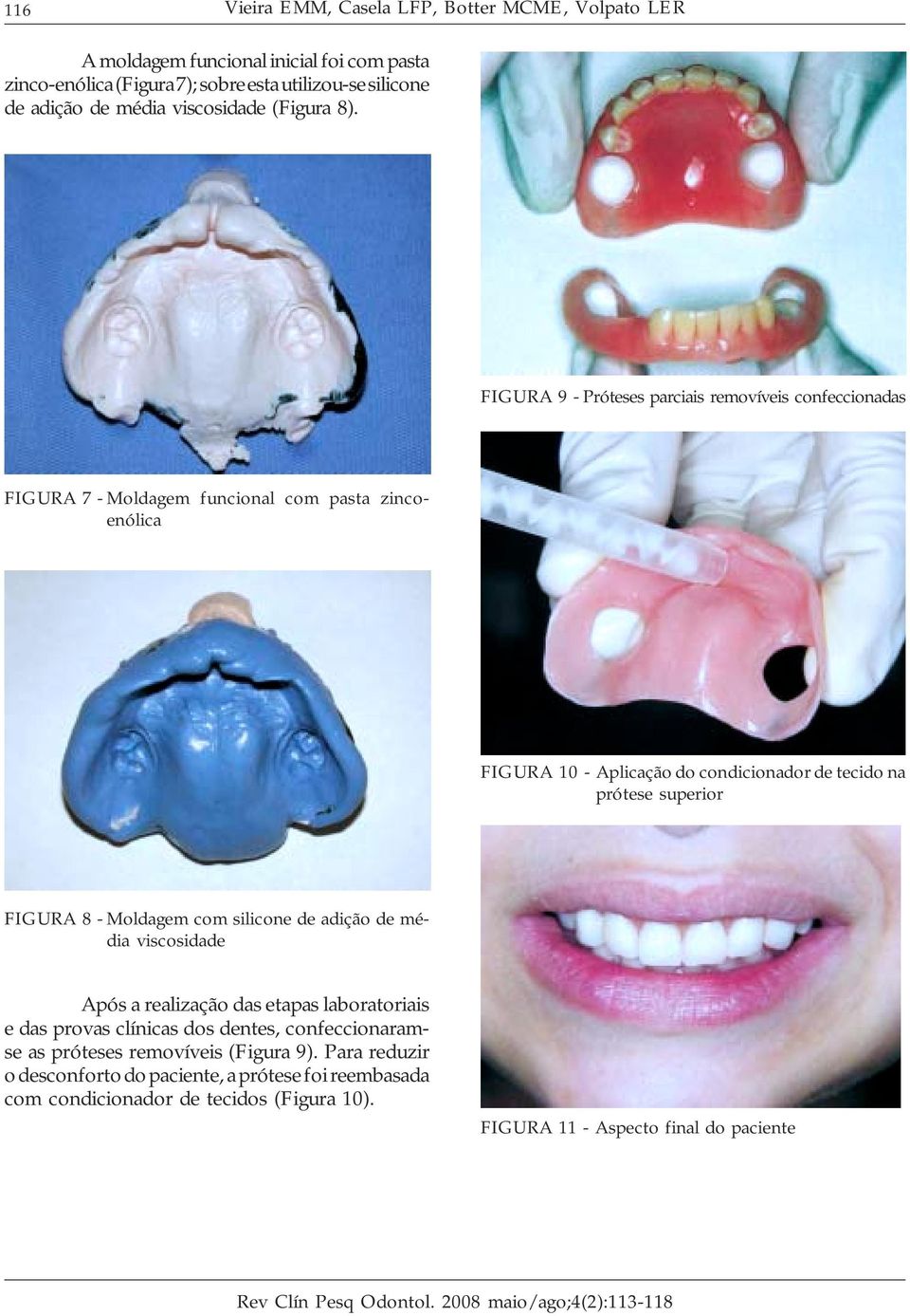 FIGURA 9 - Próteses parciais removíveis confeccionadas FIGURA 7 - Moldagem funcional com pasta zincoenólica FIGURA 10 - Aplicação do condicionador de tecido na prótese superior