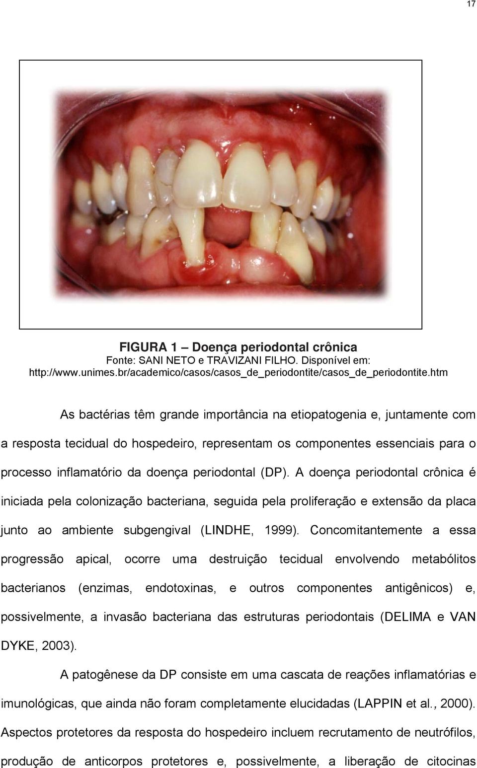 (DP). A doença periodontal crônica é iniciada pela colonização bacteriana, seguida pela proliferação e extensão da placa junto ao ambiente subgengival (LINDHE, 1999).