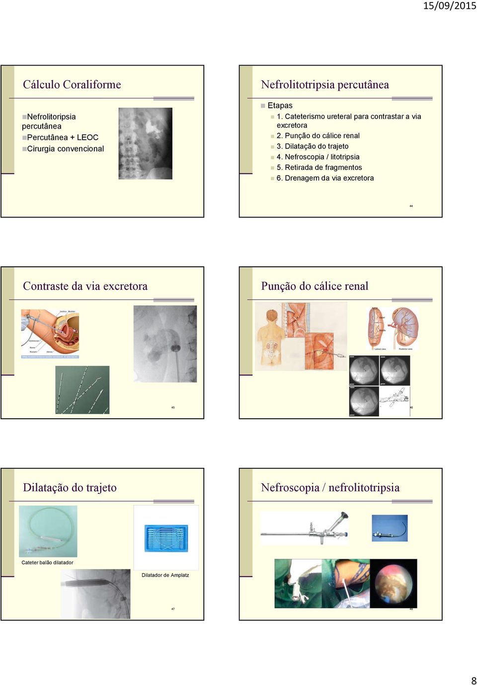 Nefroscopia / litotripsia 5. Retirada de fragmentos 6.