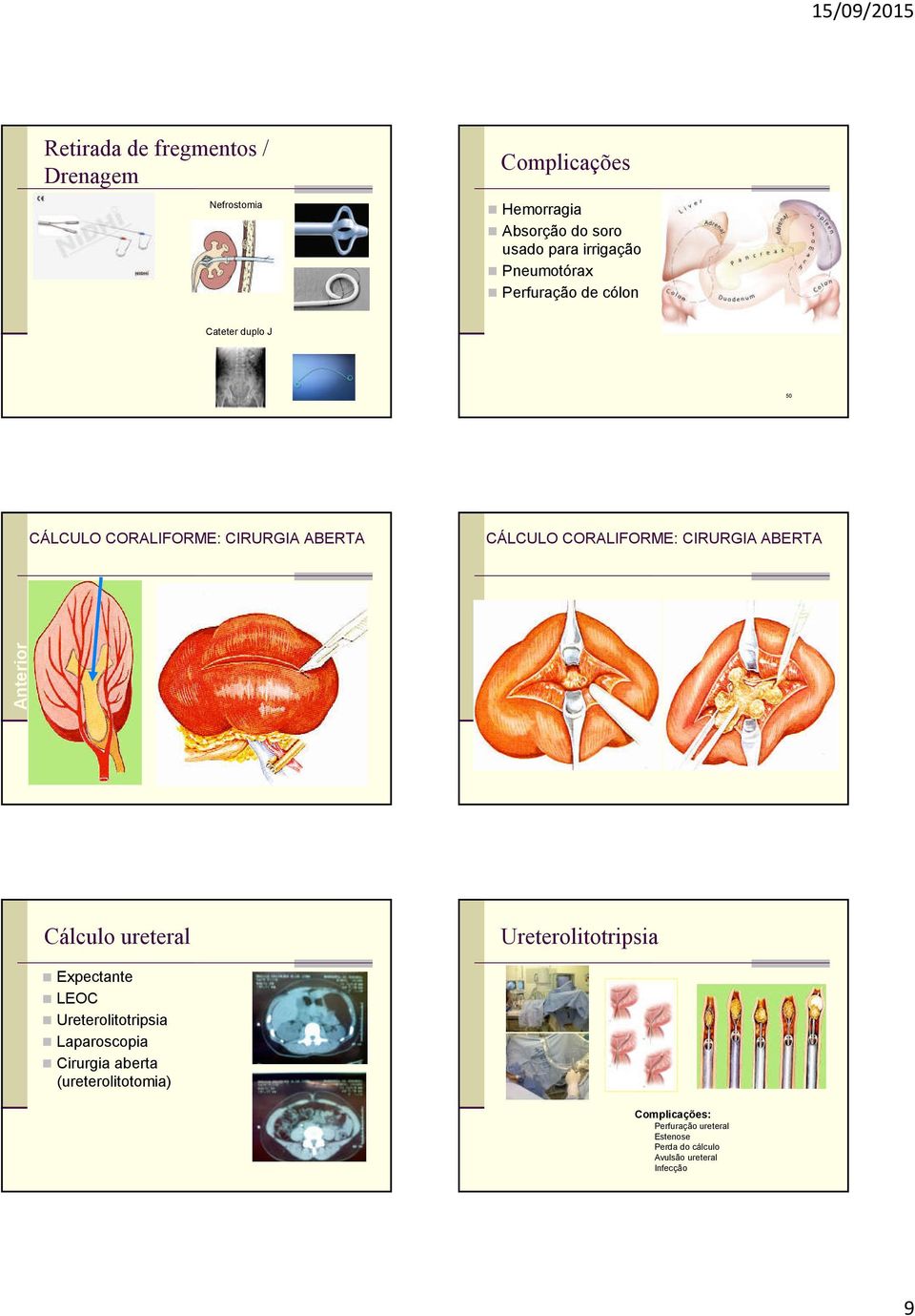 CORALIFORME: CIRURGIA ABERTA Anterior Cálculo ureteral Ureterolitotripsia Expectante LEOC Ureterolitotripsia