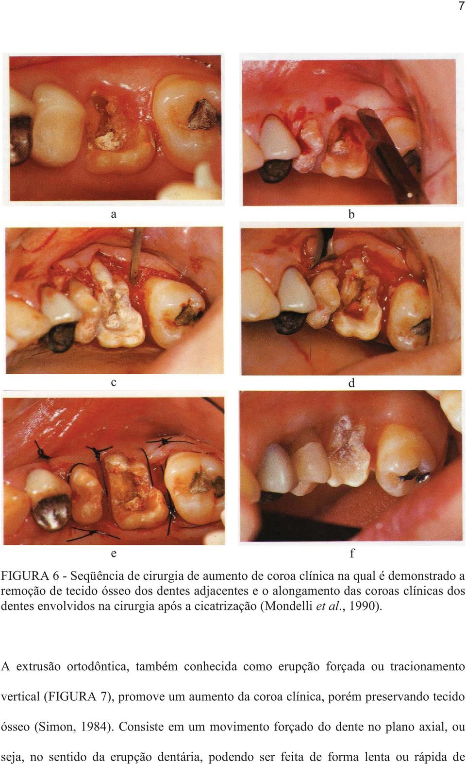 f A extrusão ortodôntica, também conhecida como erupção forçada ou tracionamento vertical (FIGURA 7), promove um aumento da coroa clínica, porém