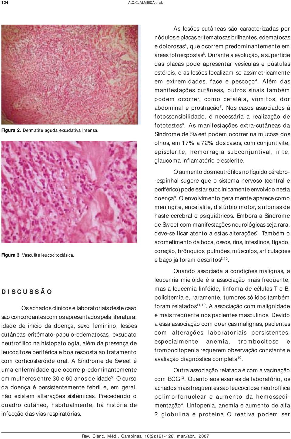 eritêmato-papulo-edematosas, exsudato neutrofílico na histopatologia, além da presença de leucocitose periférica e boa resposta ao tratamento com corticosteróide oral.