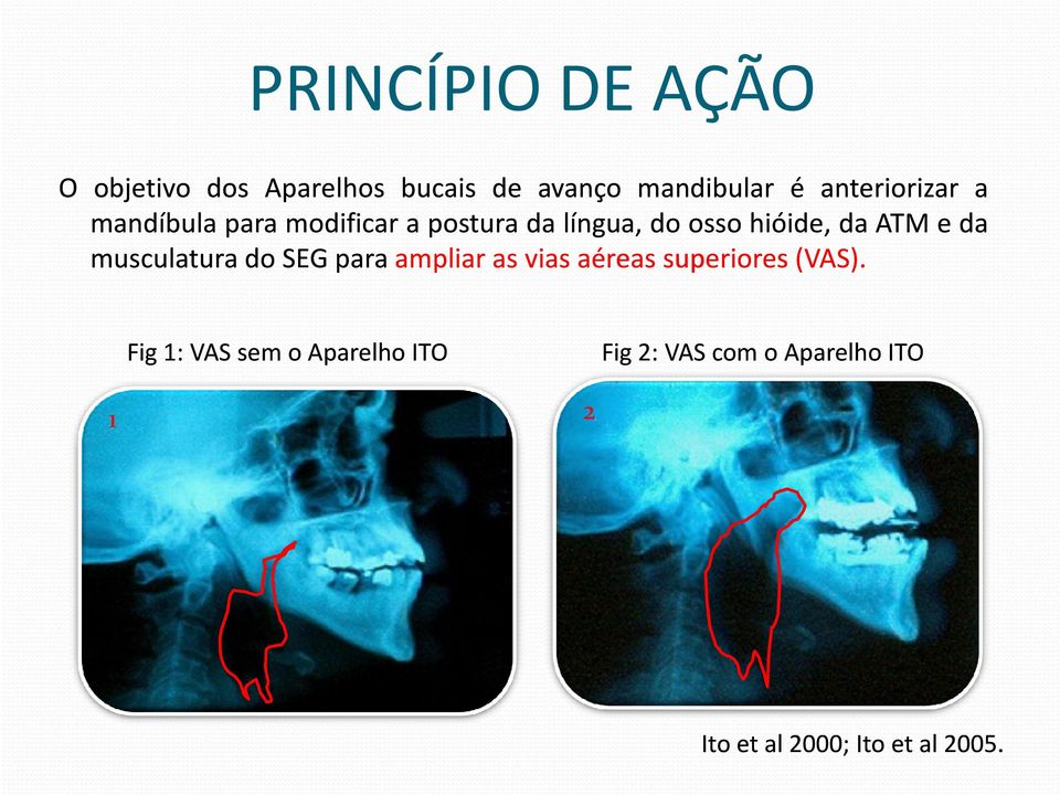 ATM e da musculatura do SEG para ampliar as vias aéreas superiores (VAS) (VAS).