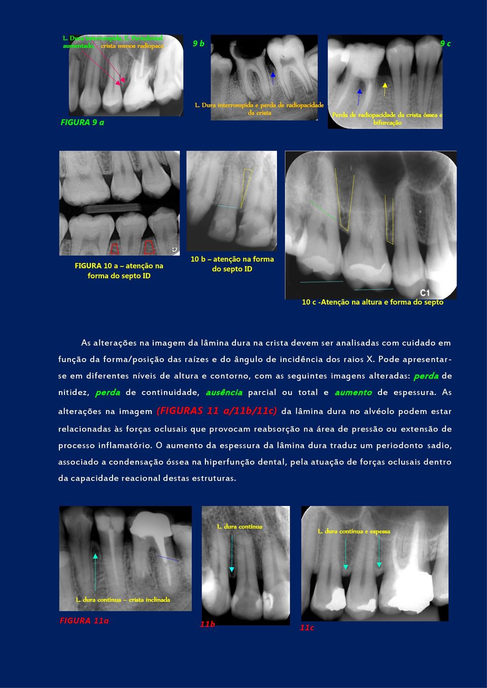 altura e forma do septo As alterações na imagem da lâmina dura na crista devem ser analisadas com cuidado em função da forma/posição das raízes e do ângulo de incidência dos raios X.