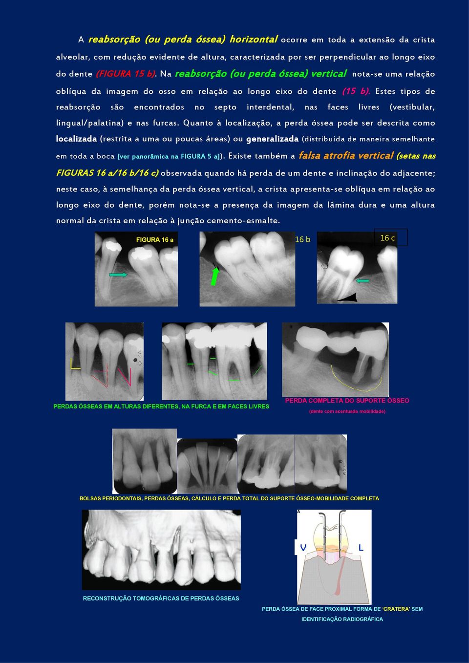 Estes tipos de reabsorção são encontrados no septo interdental, nas faces livres (vestibular, lingual/palatina) e nas furcas.