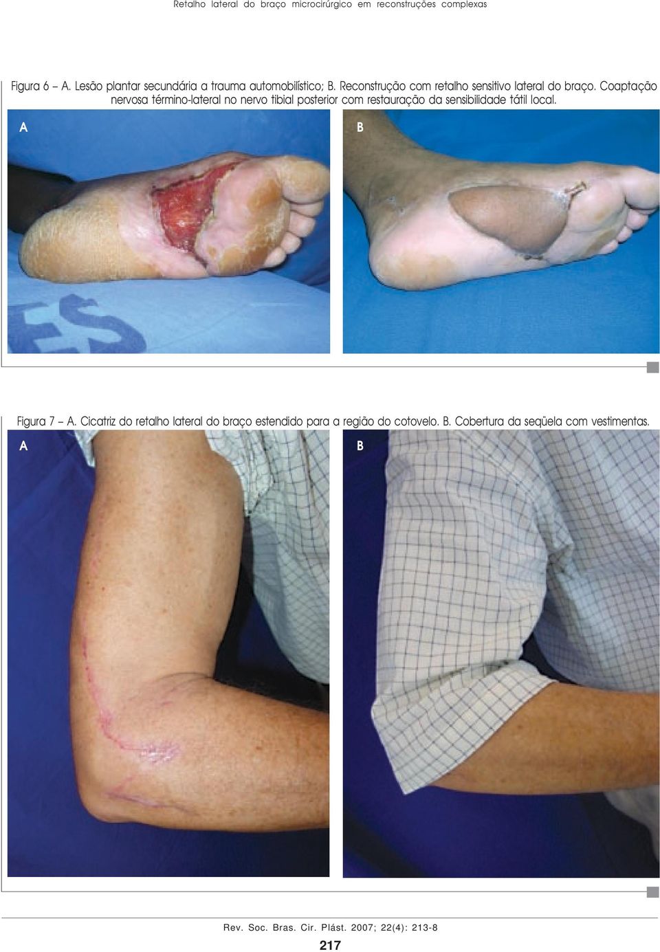 Coaptação nervosa término-lateral no nervo tibial posterior com restauração da sensibilidade tátil local.