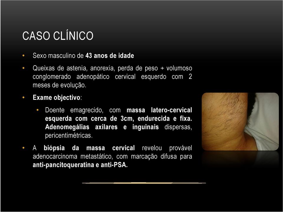 Exame objectivo: Doente emagrecido, com massa latero-cervical esquerda com cerca de 3cm, endurecida e fixa.