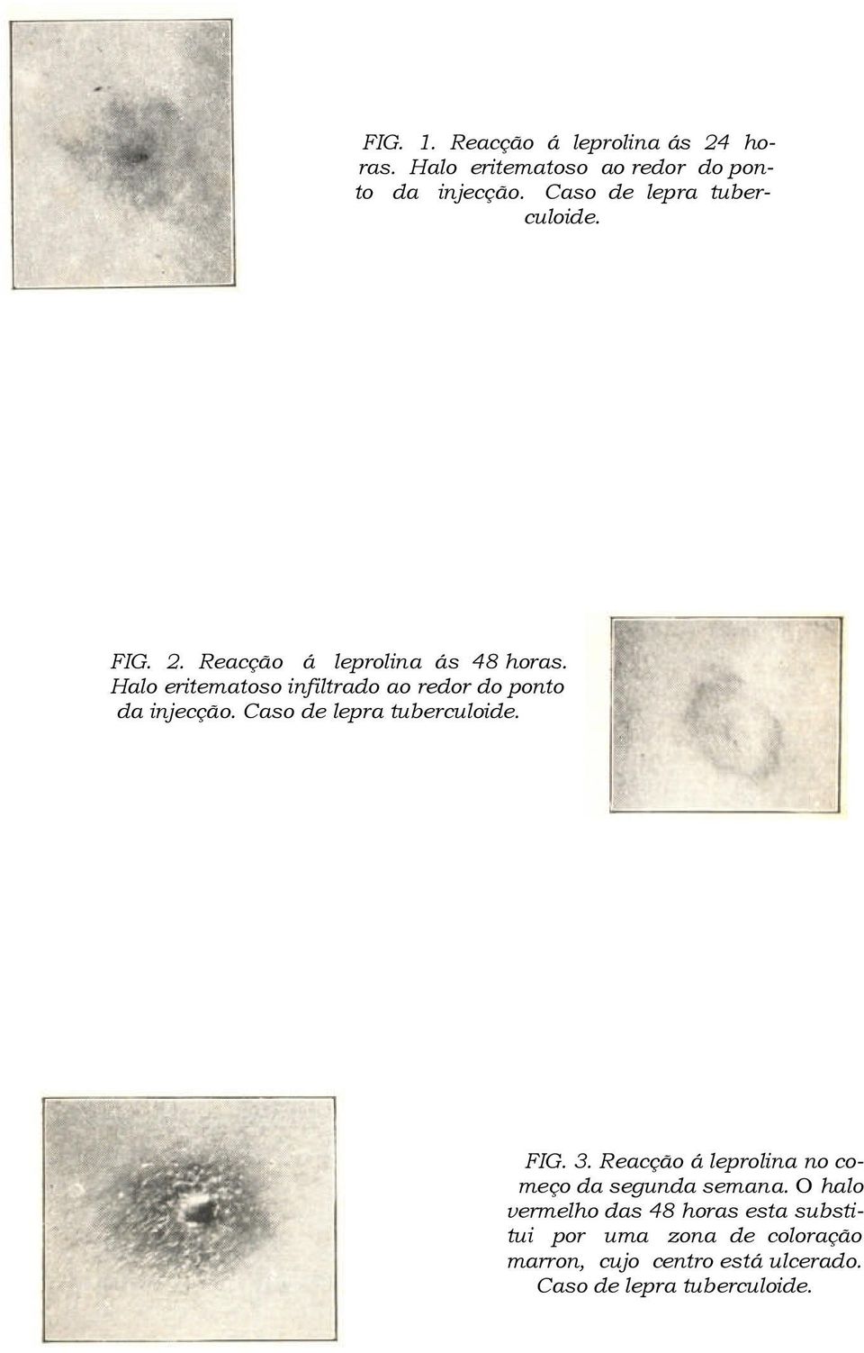 Halo eritematoso infiltrado ao redor do ponto da injecção. Caso de lepra tuberculoide. FIG. 3.