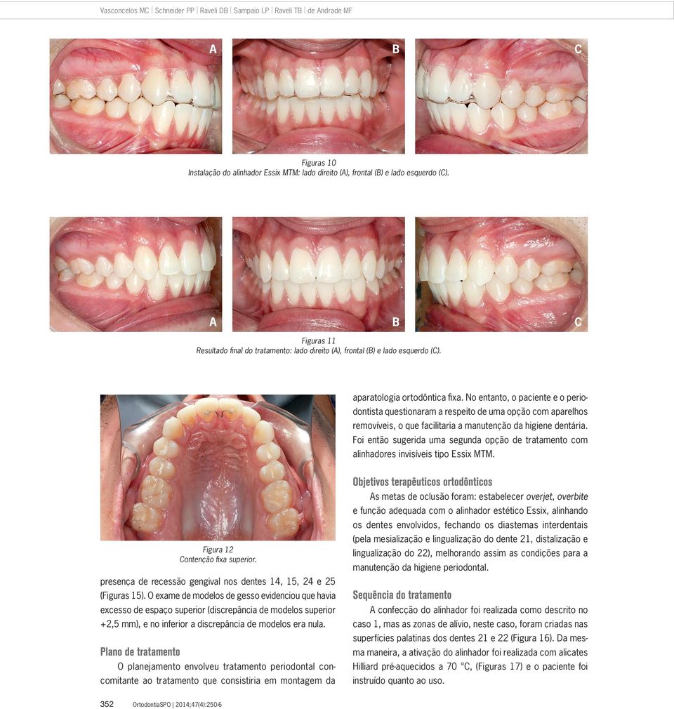 No entanto, o paciente e o periodontista questionaram a respeito de uma opção com aparelhos removíveis, o que facilitaria a manutenção da higiene dentária.