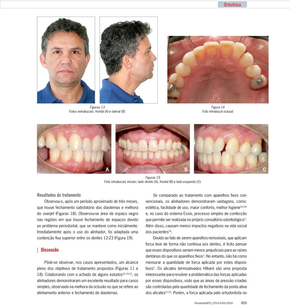 Observou-se área de espaço negro nas regiões em que houve fechamento de espaços devido ao problema periodontal, que se manteve como inicialmente.